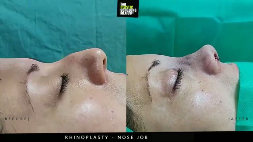 Nose Job - Rhinoplasty in Mexico - TopPlasticSurgeonsMexico 11